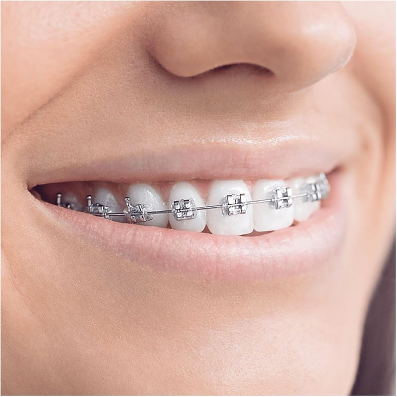 Oral-B Teen elektromos fogkefe, fogszabályzóhoz, Bluetooth-os, fehér