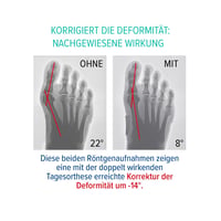 Epitact Hallux Valgus Korrekciós Ortézis L méret - Bunion Támogatás 5