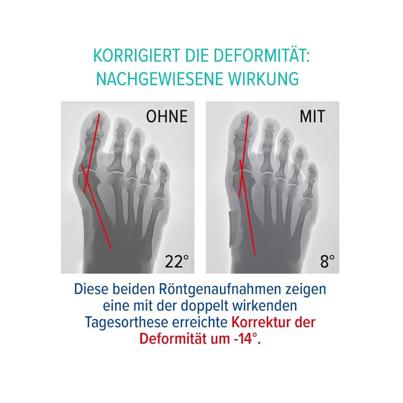 Epitact Hallux Valgus Korrekciós Ortézis L méret - Bunion Támogatás