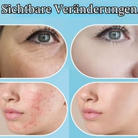 UUPAS vysokofrekvenčný kozmetický prístroj so 6 nadstavcami – prenosné zariadenie na omladenie pleti 5