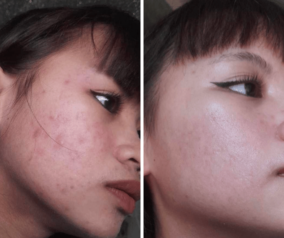 Individual with acne prone skin and has been on prescribed topicals for 3 years did not see improvements until she used 2% Salicylic Acid Cleanser for 2 months.