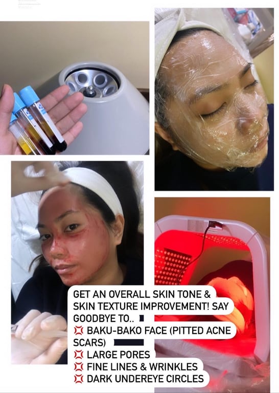 MOLD Manila - PRP Therapy