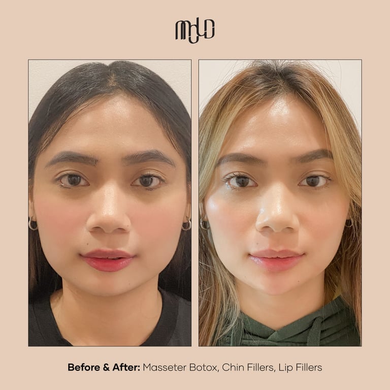MOLD MANILA | FDA Approved Fillers