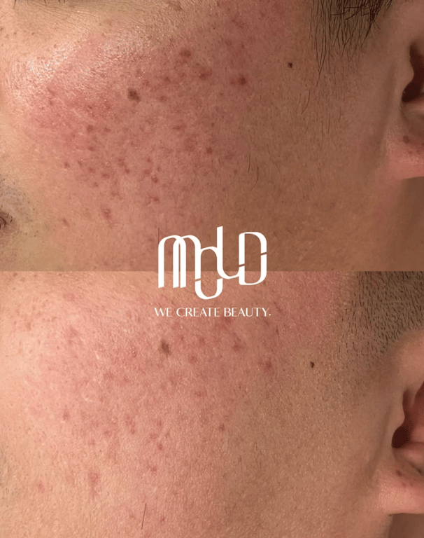 MOLD Manila | PRP Therapy