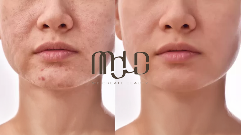 PRP and Microneedling at MOLD Manila