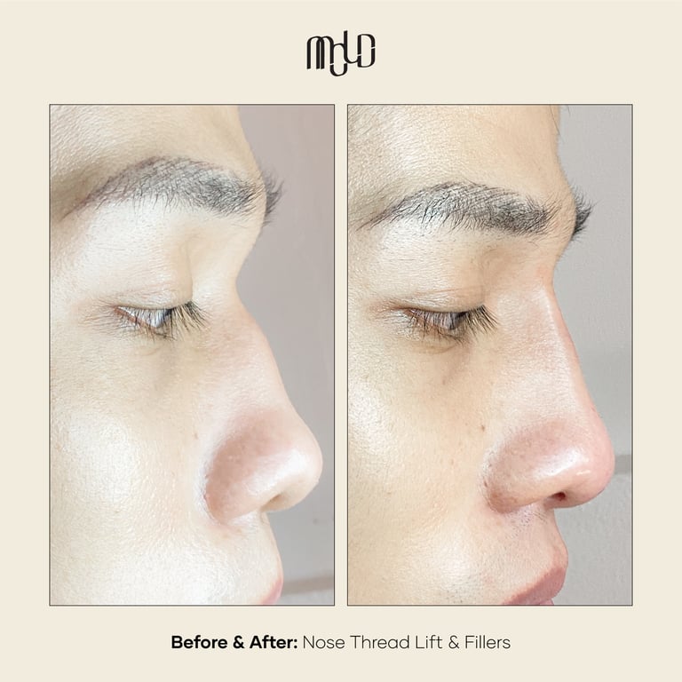 MOLD Manila | Non-Surgical Rhinoplasty | HIKO nose thread lift