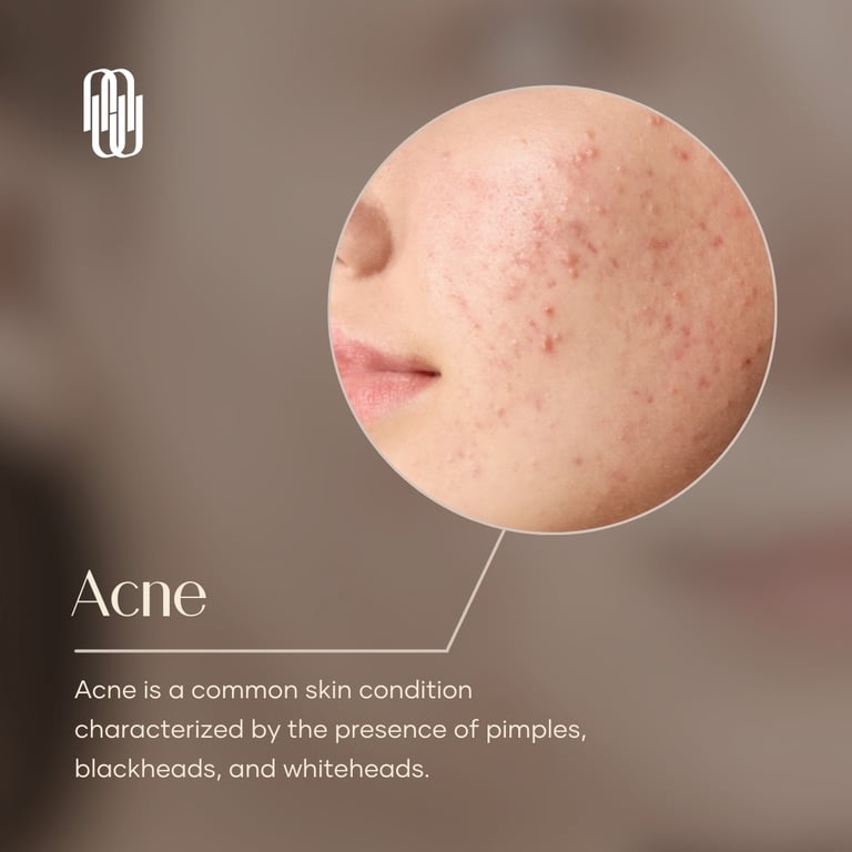 Mold Manila | What is an acne?