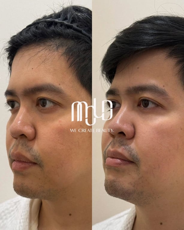 Side-by-side facial comparison showing changes after XERF treatment.