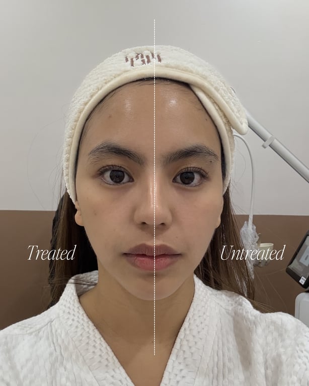 Visible lifting and tightening after just one XERF treatment session.