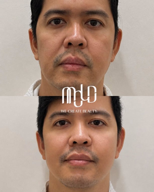 Facial comparison highlighting natural-looking changes following XERF treatment.