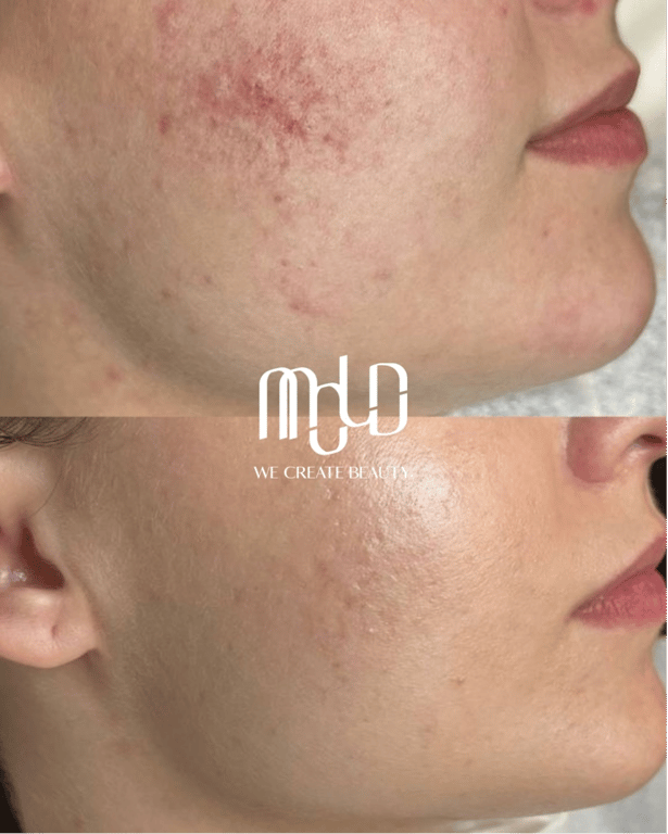 Non-surgical facial rejuvenation