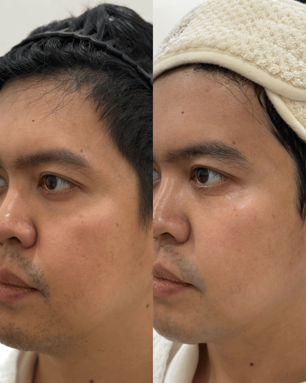 Subtle contour and skin-tightening improvements with XERF RF treatment.