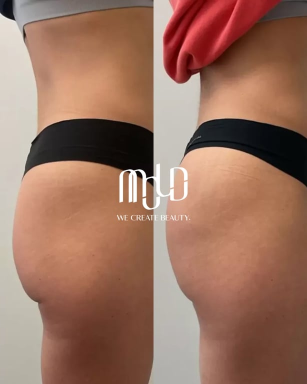 Mold Manila Introduces PLLA Collagen–Stimulating Injections for Hip Dip Management | PR