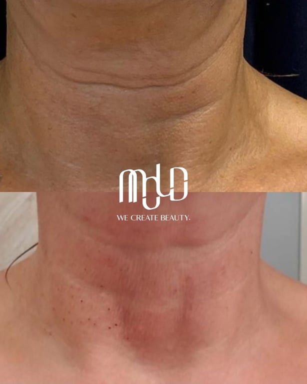 Visible improvement in neck laxity and skin quality following treatment.