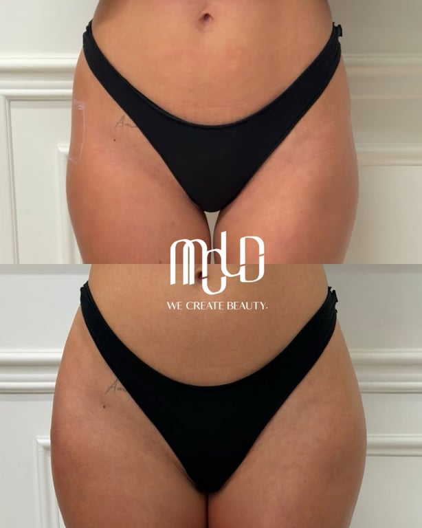 Mold Manila | PLLA Collagen–Stimulating Injections for Hip Dip
