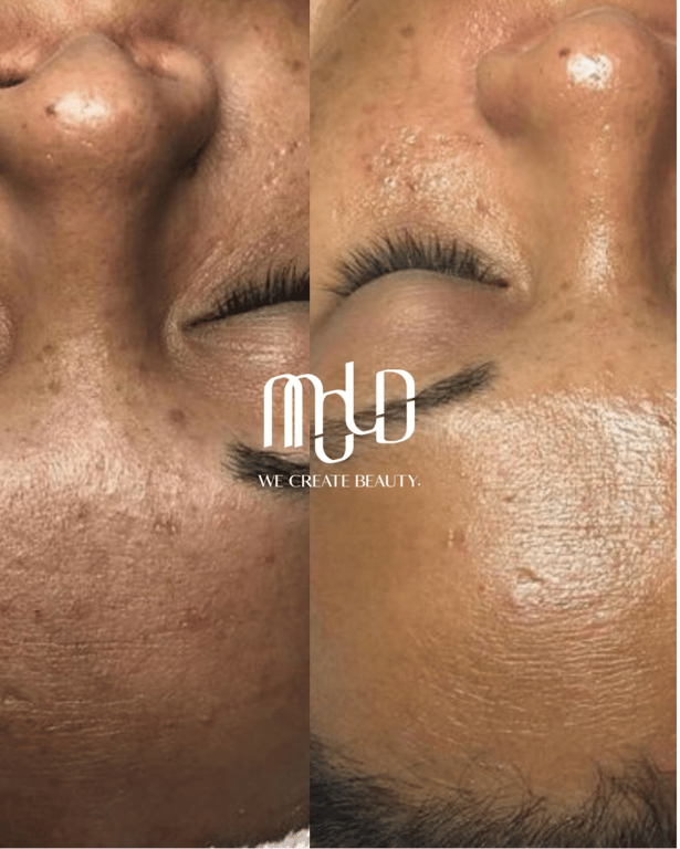 Mold Manila | Melanocure