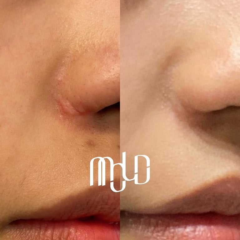 Mold Manila | Scar Induction Program