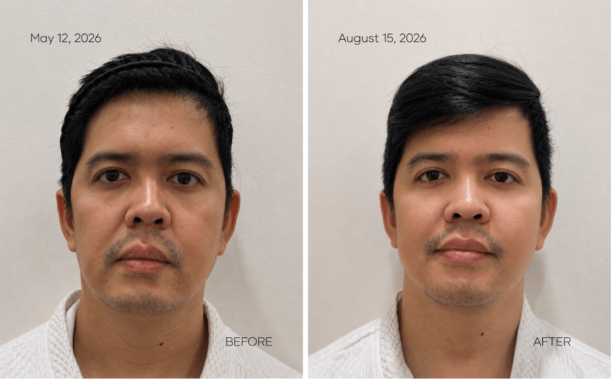 MOLD Manila Shares Three-Month Patient Results From XERF Skin Tightening
