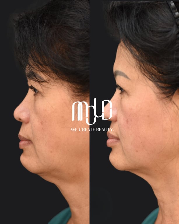 Mold Manila Unveils XERF Skin-Tightening at White Plains Branch in Quezon City