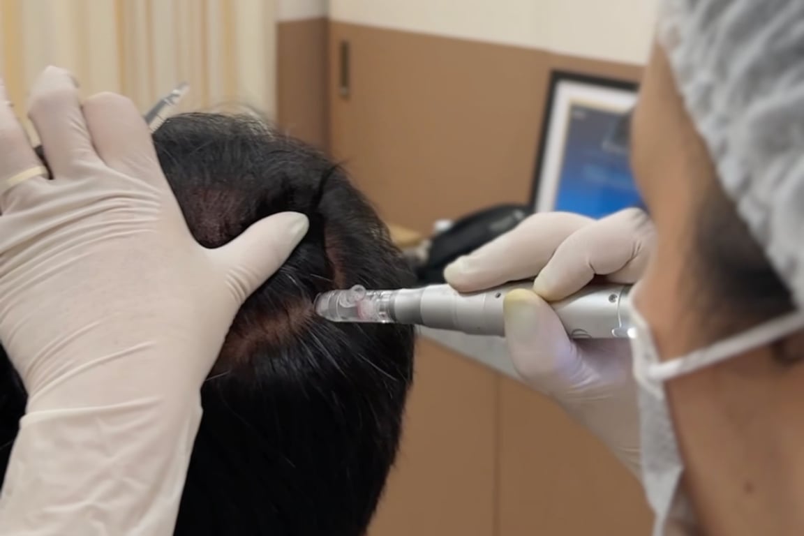 Mold Manila | Advanced Scalp Treatment