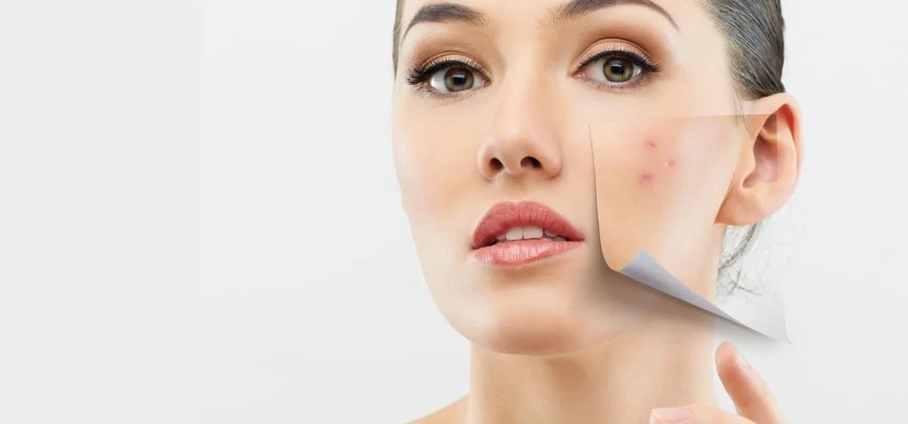 adult acne | Longevity LIVE