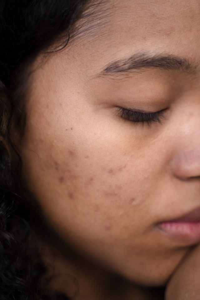 Hyperpigmentation: Busting 5 of the Most Common Myths