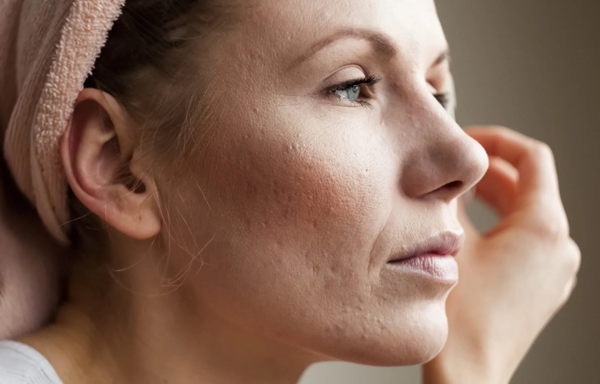 adult acne | Longevity Live