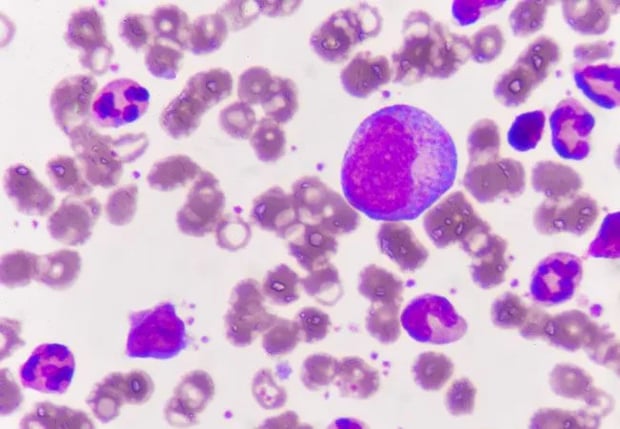 Leukemia