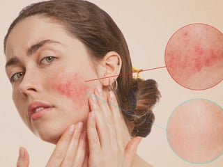 rosacea