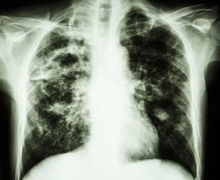 Tuberculosis