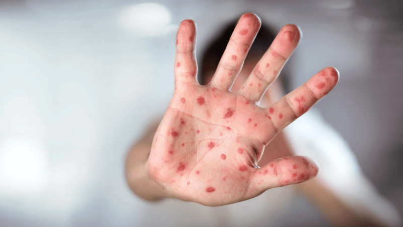 Over 100 children killed as measles outbreak spreads to 7 districts