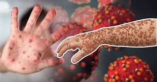 10 more children die with measles symptoms, death toll crosses 550