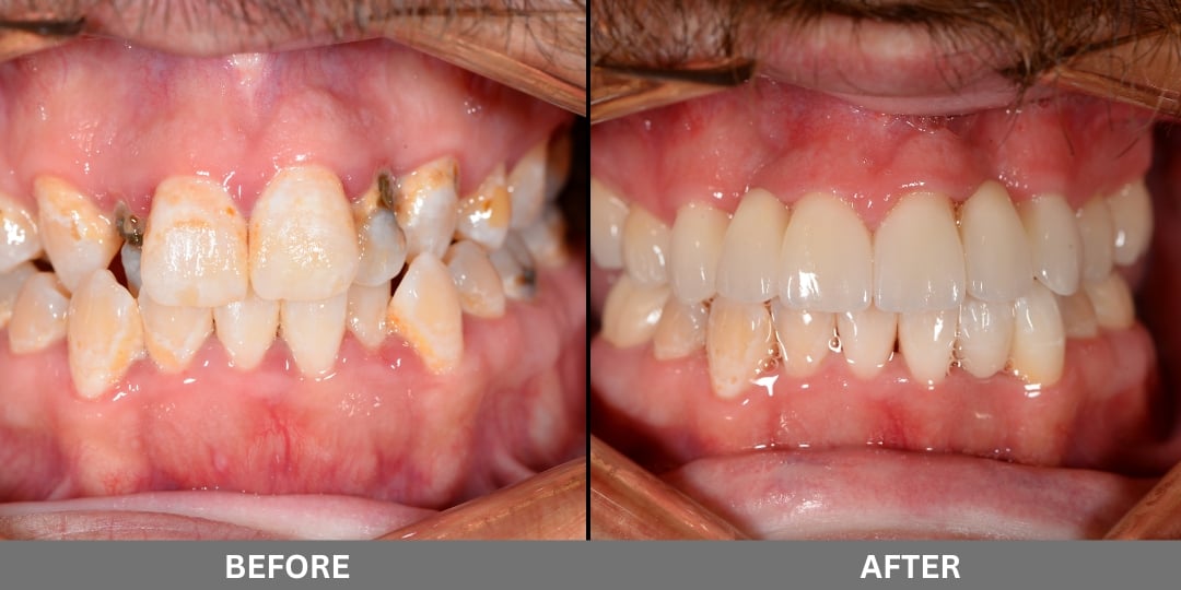Before and After Dental Implants - Patient 1