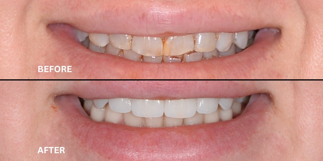 Dental Implants Before and After Patient 2