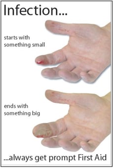 Picture of Infection Always Get Prompt First Aid Poster - 525 x 775Hmm - Encapsulated Paper - [AS-POS21]