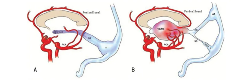 The formation of VGAM. (A) Normal vessel structure between the pericallosal arteries and the PCA is present in embryonic period. (B) The abnormal high-output arteriovenous connection contributes to aneurysmal dilation of the MProsV, which leads to the formation of VGAM. This connection drains into the SS and subsequently into T. In addition, it also bleeds into the FS and then into the AT when the SS is absent, hypogenetic, or stenotic. Reproduced with permission from Mortazavi et al. AT, accessory torcula; FS, falcine sinus; MProsV, median prosencephalic vein; MRI, magnetic resonance imaging; PCA, posterior cerebral arteries; SS, straight sinus; T, torcula; VGAM, vein of Galen aneurysmal malformation.