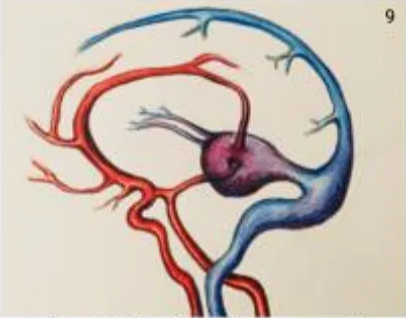 Direct, high-flow shunts on the wall of the draining vein