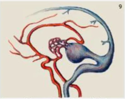 Interposing arterial network between feeders and the draining vein
