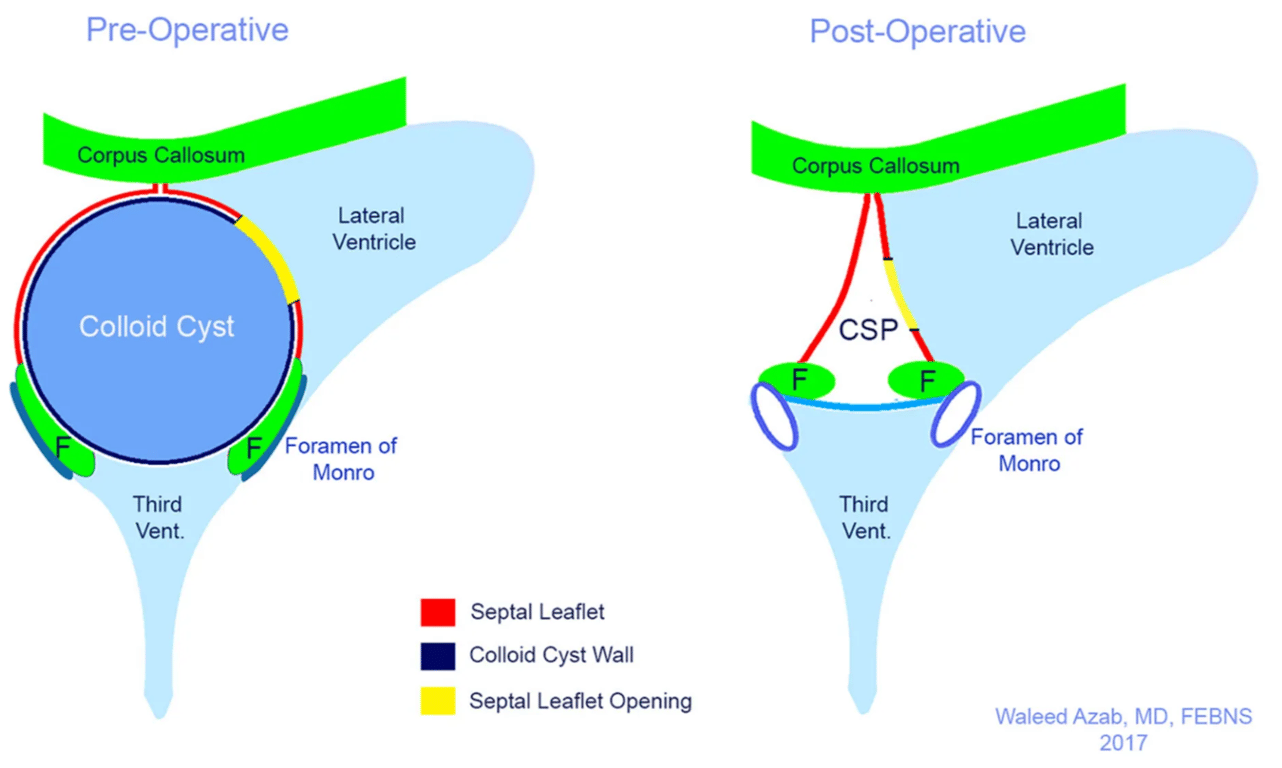 Illustration of the patho-anatomical relations of large colloid cysts before and after being excised via the trans-septal approach. The septal leaflet, colloid cyst wall, and the forniceal column (F) inferolateral displacement is demonstrated. The cavum septae pellucidi (CSP) becomes appreciable after cyst excision.