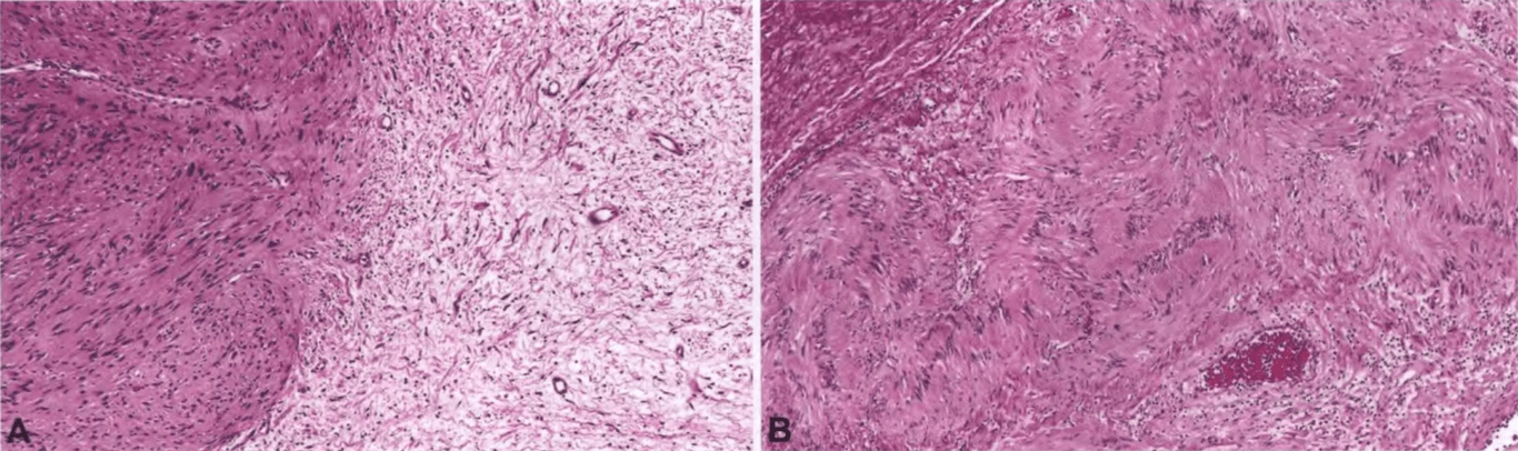 Schwannoma. (A) Compact Antoni A (left) and loose Antoni B (right) areas. (B) A capsule (upper left) surrounds a compact Antoni A region with nuclear palisades, consistent with Verocay bodies. 
