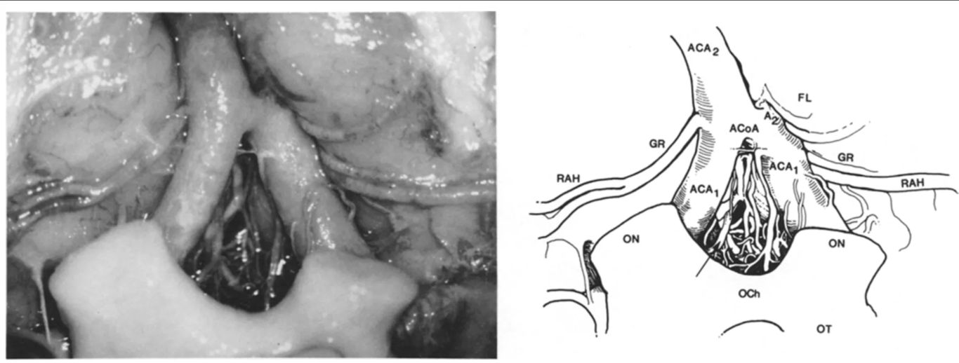 Inferior aspect of the preoptic area. Double recurrent artery of Heubner (RAH) originating from a common trunk off the A₂ segment of the anterior cerebral artery (ACA₂). Note multiple perforating branches from the proximal anterior cerebral (ACA₁) and anterior communicating arteries (ACoA, arrow). OCh = optic chiasm; ON = optic nerve; OT = optic tract; GR = gyrus rectus; FL = frontal lobe.