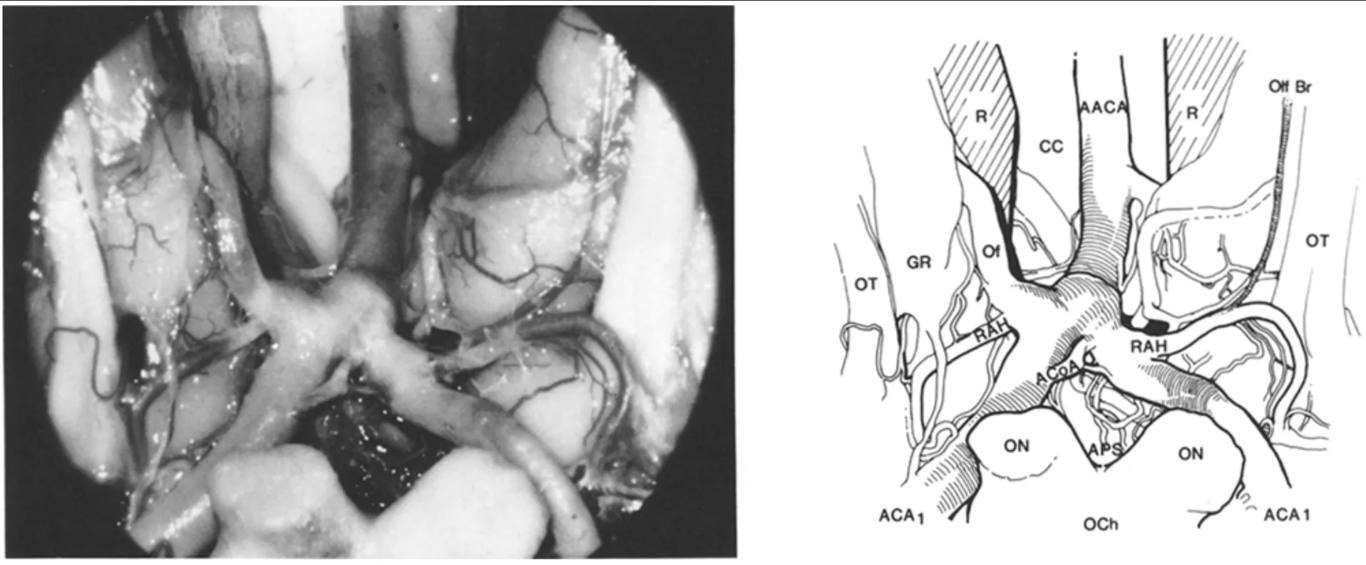 Inferior view of the anterior circle of Willis in a specimen with an azygous anterior cerebral artery (AACA). On the left, the recurrent artery (RAH) originates from an early orbitofrontal branch (Of). On the right, the olfactory branch (Olf Br) of Heubner's artery runs parallel to the olfactory tract (OT). Note the accessory anterior communicating artery (ACoA). ON = optic nerve; OCh = optic chiasm; APS = anterior perforated substance; ACA₁ = proximal segment of the anterior cerebral artery; GR = gyrus rectus; CC = corpus callosum; R = brain retractor.