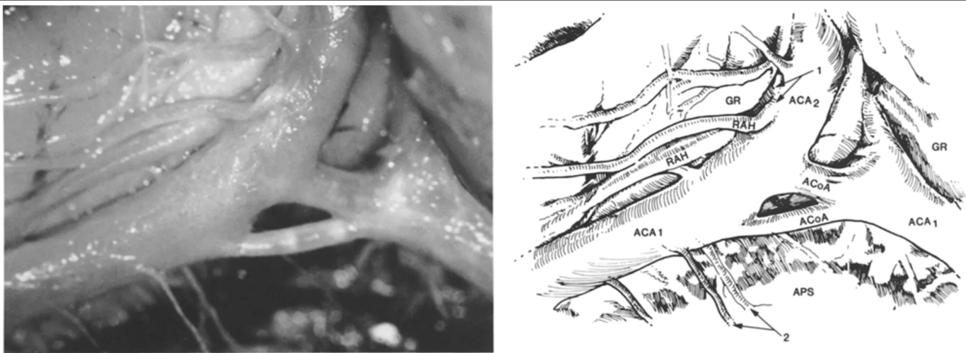 Double recurrent artery of Heubner (RAH) with separate origins from the A₂ segment of the anterior cerebral artery (ACA₂) (arrows 1), as seen from the inferior aspect of the anterior circle of Willis. The proximal segment of the anterior cerebral artery (ACA₁) and its perforating branches (arrows 2) are also shown. Note the double anterior communicating artery (ACoA). GR = gyrus rectus; APS = anterior perforating substance.