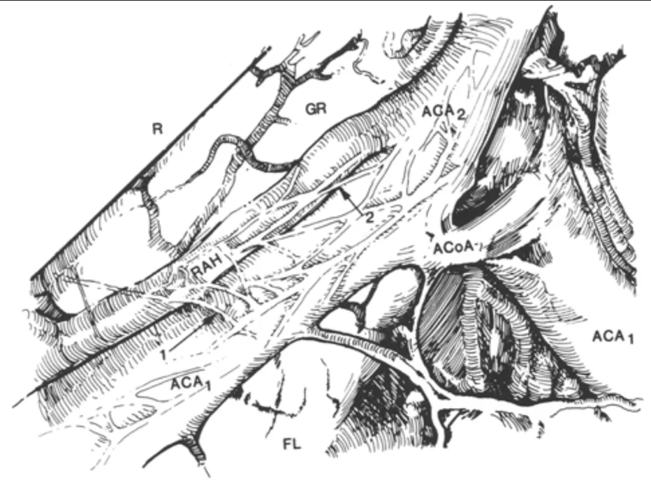 Inferior view of the rostral circle of Willis showing the Type I course (see text) of the recurrent artery of Heubner (RAH). Note the arachnoid strands (arrow 1) between the proximal anterior cerebral artery (ACA₁) and the RAH, as well as the attachment between the two vessels (arrow 2). ACoA = anterior communicating artery; FL = frontal lobe; ACA₂ = distal segment of the anterior cerebral artery; GR = gyrus rectus; R = brain retractor.