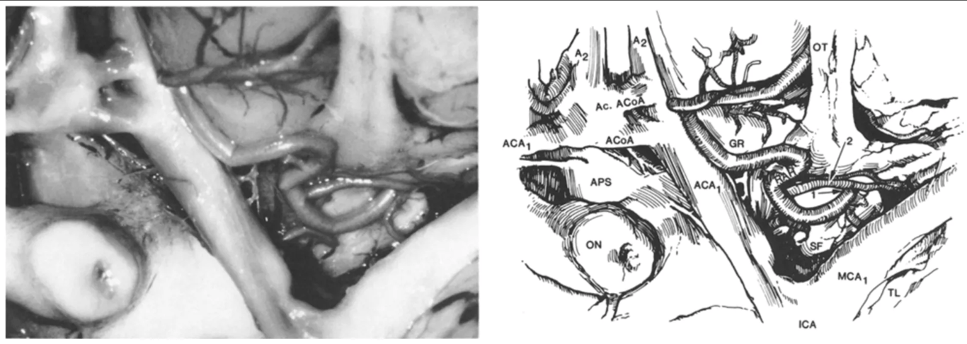 Inferior view of the anterior circle of Willis showing the point of penetration of the recurrent artery of Heubner (RAH) in the Type III course. The internal carotid bifurcation was lifted to show the entrance point (arrow 1) into the brain of the Heubner's artery, at the level of the Sylvian fissure (SF). Note the Sylvian branches of the recurrent artery (arrow 2). ON = optic nerve; MCA₁ = proximal middle cerebral artery; ACA₁ = proximal anterior cerebral artery; A₂ = distal anterior cerebral artery; OT = optic tract; GR = gyrus rectus; TL = temporal lobe; Ac.ACoA = accessory anterior communicating artery; APS = anterior perforating substance.