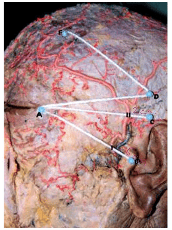 The course of the STA and its branches. We used some landmarks on the head (A, B, C, D, F points). Straight lines joined these points (AB, AC, and AD). Line DF, according to Juri's original flap, begins at the point 2 cm above the ear, and is directed anterosuperiorly 45° above line AD to the anterior hairline. The F point was over the anterior hairline. The course of the STA and its branches were defined according to these lines and points. Bifurcation of the STA above the zygomatic arch
