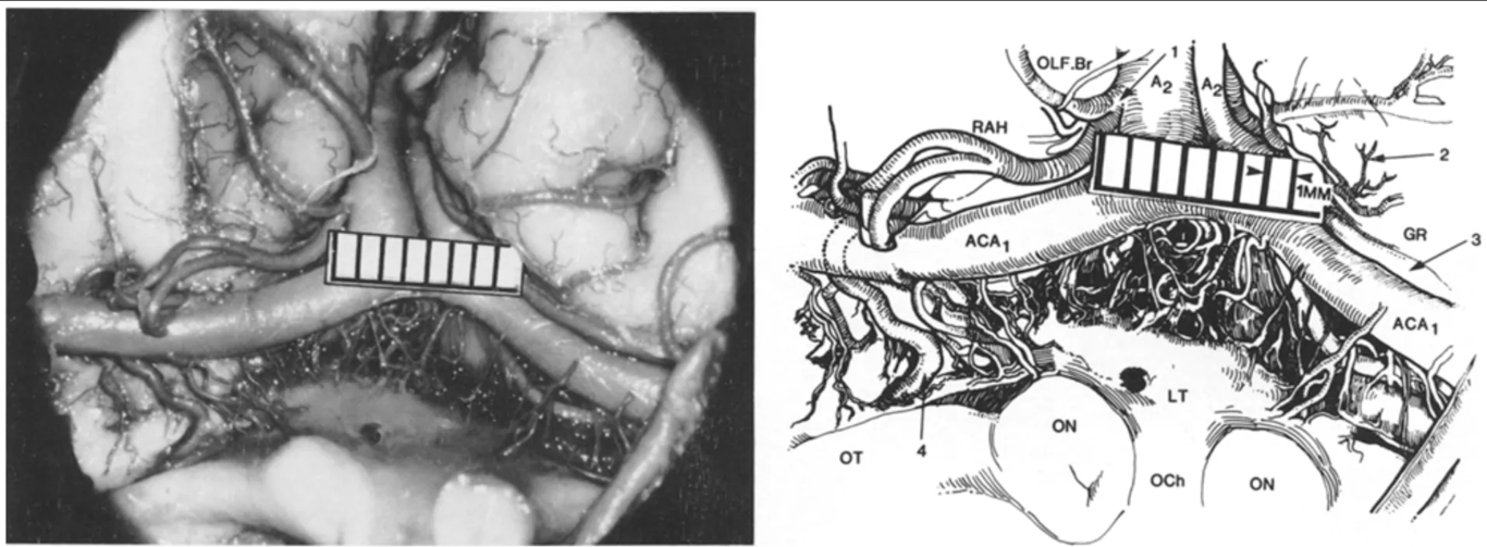 Inferior view of the base of the brain. On the left, a double recurrent artery of Heubner (RAH), originating from a common stem (arrow 1) off the distal anterior cerebral artery (A₂). Note the early olfactory branch of the recurrent artery (OLF.Br). Frontal branches (arrow 2), Type 1 course (arrow 3), and the RAH perforating the brain in the anterior perforating substance are also shown (arrow 4). ON = optic nerve; OCh = optic chiasm; OT = optic tract; ACA₁ = proximal segment of the anterior cerebral artery; LT = lamina terminalis; GR = gyrus rectus.