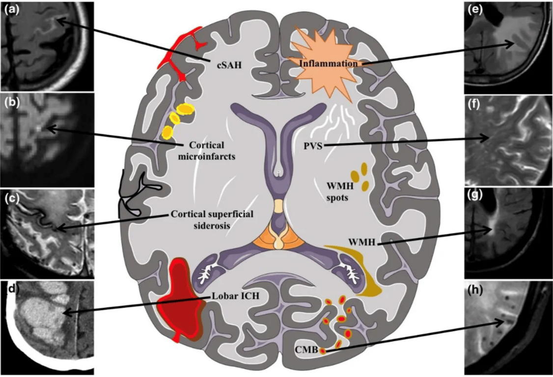 Schematic representation of the neuroimaging spectrum of manifestations of cerebral amyloid angiopathy. 
