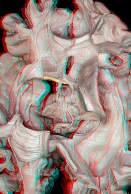 AC is shown superficial to it is the columns of the fornix that looks like a wish bone and at the base of the columns is the mammillary bodies