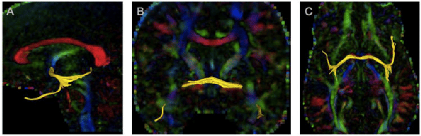 Ant commissure in yellow